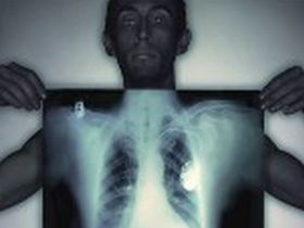 Туберкулез, фото с сайта antirak-center.ru 