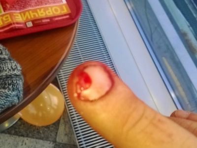 Травмированный палец Алексея Ходорыча. Фото с его страницы в Facebook