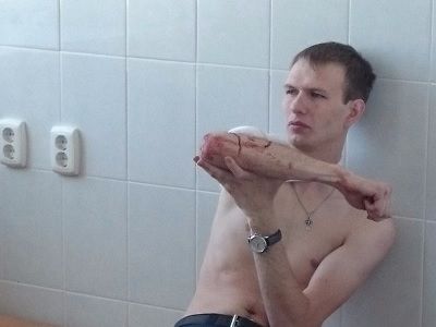 Ранение журналиста Олега Куницына Фото: twitter.com/Domozhiroff